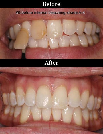 Patient's teeth before and after internal bleaching