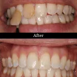 Patient's teeth before and after internal bleaching