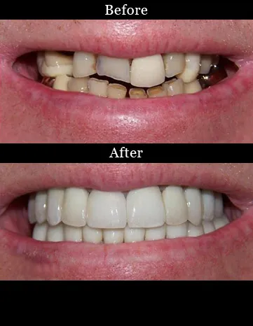 Patient's teeth before and after full mouth reconstruction