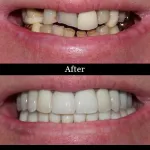 Patient's teeth before and after full mouth reconstruction