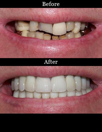 Full Mouth Reconstruction - Before and After