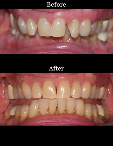 Patient's teeth before and after Invisalign