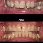 Patient's teeth before and after Invisalign