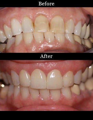 Patient's teeth before and after dental crowns