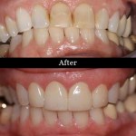 Patient's teeth before and after dental crowns