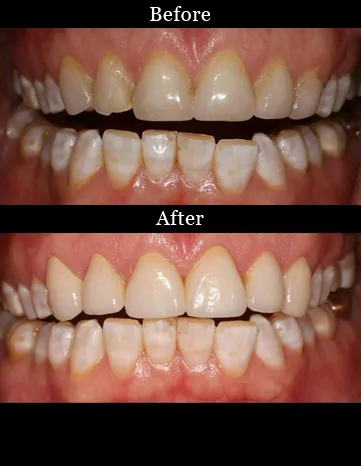 Patient's teeth before and after dental crowns