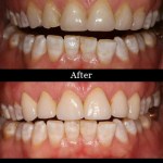 Patient's teeth before and after dental crowns