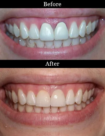 Patient's teeth before and after dental crowns
