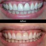 Patient's teeth before and after dental crowns