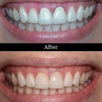 Dental Crowns - Before and After